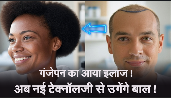 गंजेपन का इलाज